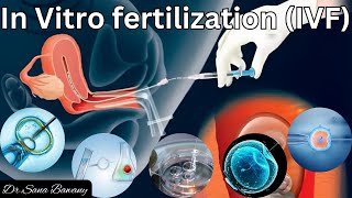 IVF Complete Process Step By Step  In Vitro Fertilization Procedure [upl. by Margalit383]