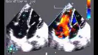 Noncoaptation of Tricuspid valve [upl. by Zaller]