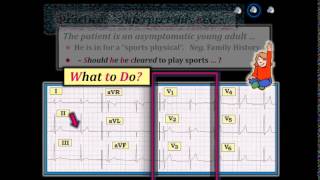 ECG Video14 Blog 117  Brugada Syndrome 9712015 [upl. by Norabel153]