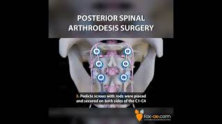 Posterior Spinal Arthrodesis Surgery [upl. by Einaeg]