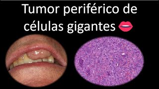 👄 Tumor periférico de células gigantes  Cavidad oral  Cabeza y Cuello  Patología [upl. by Niatsirhc912]