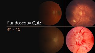 Fundoscopy Quiz [upl. by Giark]