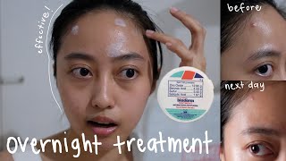 PAANO GAMITIN ANG BIODERM OINTMENT FOR ACNE OVERNIGHT PIMPLE TREATMENT  I am Marta Cervanez [upl. by Euphemie]