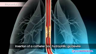 Esophageal Stent [upl. by Ailic99]