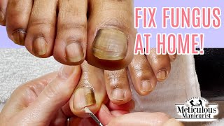 Toenail Fungus Cleaning at Home Success [upl. by Magnien]