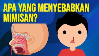 Apa yang Menyebabkan Mimisan [upl. by Mal]