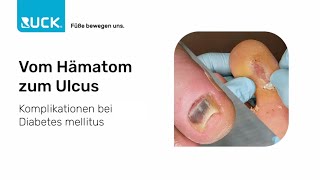 Diabetischer Fuß  vom Hämatom zum Ulcus  Fallbeispiel [upl. by Pennie]