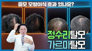 정수리 가르마 모발이식 증모 효과 있나요 영구적인 동반탈락이 걱정이신 분 걱정 끝 [upl. by Melda362]