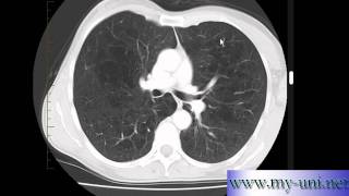 Emphysema on CT scan of Chest [upl. by Wolram90]