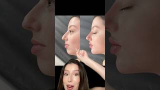 Filler before amp after filler lipfiller chinfiller nosefiller beforeandafter botox fillers [upl. by Parrisch594]