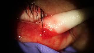 Chalazion Popped on inner eyelid w needle [upl. by Llennej610]