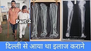 tibia bone fracture recovery without surgery दिल्ली से इलाज कराने आया था मरीज। [upl. by Martine]