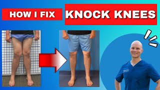 The ONLY way to Fix Knock Knees  Get The Facts [upl. by Tilda]