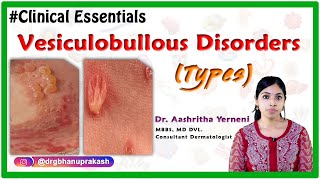 Vesiculobullous disorders Types Clinical essentials DrAashritha yerneni [upl. by Akemehs487]