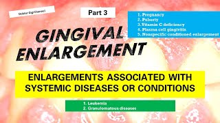 Part 3  Gingival Enlargement Pembesaran Gingiva yang dihubungkan dengan penyakit sistemik [upl. by Akimot]