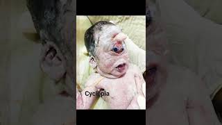 Cyclopia Cyclocephaly Synophthalmia   Rare form of holoprosencephaly amp its congenital disorder [upl. by Yenhoj400]