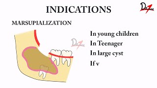 HOW IS MARSUPIALIZATION DONE [upl. by Aerdnaz]