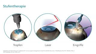Endlich keine Augentropfen mehr Aktuelles von den VorderkammerImplantaten bei Glaukom [upl. by Neelhtac814]