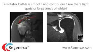 How to read your shoulder MRI with Dr Centeno of Regenexx [upl. by Worl]