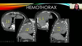 CXR The Pleural Space [upl. by Gypsie]