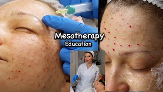 Mesotherapy for Face including around the Eyes injection technique using 13mm 30G needle [upl. by Ayifa]