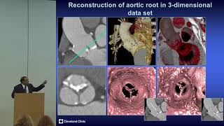 Imaging in Marfan Syndrome [upl. by Rhodia]