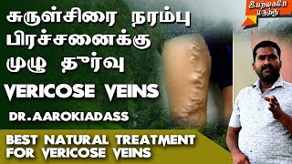 Vericose Veins Treatment Tamil  Vericose Veins Natural Home Remedies Tamil  vericose veins [upl. by Zora981]