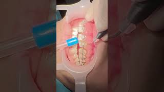 Laser gingivectomy to treat the swelled gum during bracestreatment and to correct the gummysmile [upl. by Yetty]