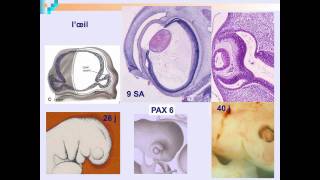 Embryofoetopathie alcoolique  Dr AnneLise DELEZOIDE partie 3 [upl. by Acinoed]