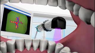 Detector de Caries Spectra  Air Techniques [upl. by Evetta]