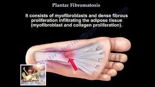 Plantar Fibromatosis  Everything You Need To Know  Dr Nabil Ebraheim [upl. by Nohsad]