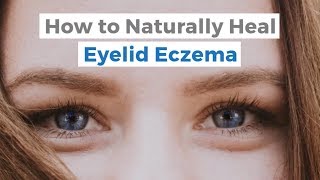 How to Naturally Heal Eyelid Eczema  Itchy Eyelid Remedies [upl. by Monia660]