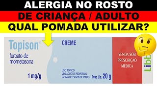 Alergia no rosto como curar Qual pomada usar para alergia em criança Na boca de criança Topison [upl. by Nidnarb]