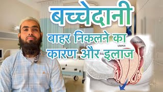 बच्चेदानी के खिसक आने का कारण और उसका इलाज ।what is uterus prolapse amp its exercisePelvic floor इलाज [upl. by Aznecniv]