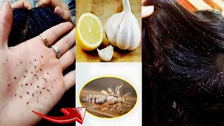 Remove Lice Naturally with Lemon Juain Khatam Karne Ka Tarika [upl. by Yancey]