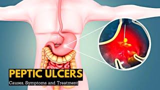 Peptic Ulcers Causes Signs and Symptoms Diagnosis and Treatment [upl. by Cavuoto869]