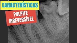 QUAIS SÃO AS CARACTERÍSTICAS DE UMA PULPITE IRREVERSÍVEL  QUICK TIP ENDOLOVERS [upl. by Eudoxia]