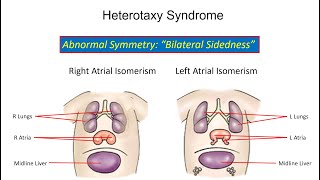 Fetal Echo Understanding Cardiovascular Abnormalities in Heterotaxy Syndrome [upl. by Jonati]