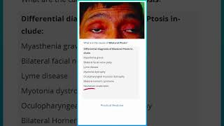 Causes of Bilateral Ptosis [upl. by Odranoel]