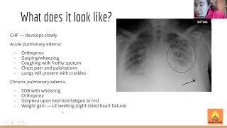 Pulmonary Edema  NPTE Prep [upl. by Leahciam59]