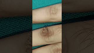 Wart removal tauba short dermatologist doctor wartremoval skincare vrialshort soniasrivas [upl. by Noevart]