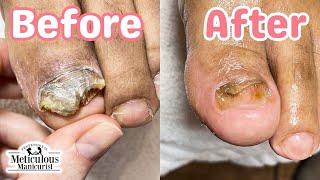 👣Tips to Treat Big Toenail Fungus at Home👣 [upl. by Itsirc559]