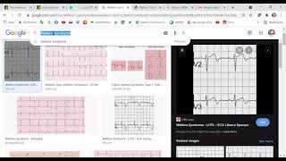 MRCP PART TWO PASSMEDICINE 2020 Cardiology 36 [upl. by Nwahsram]