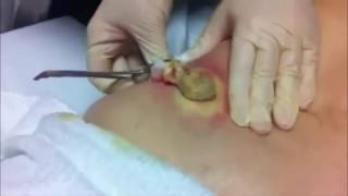 AMAZING CYST REMOVAL VERY SATISFYING [upl. by Amato]