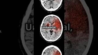 SturgeWeber Syndrome Mnemonic medicalstudent medicaleducation usmlepreparation DiagnosticLens [upl. by Aulea]