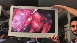 Laparoscopic Right Radical Nephrectomy for Rt Renal mass unedited speed 35 [upl. by Erbua384]