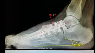 Charcot foot medial column reconstruction [upl. by Oruntha]