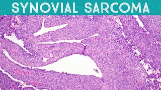 Synovial Sarcoma explained in 5 minutes Soft Tissue Pathology Basics [upl. by Claudina]