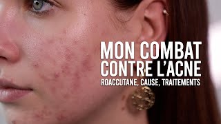 MON COMBAT CONTRE LACNÉ CAUSE TRAITEMENTS amp MON AVIS SUR ROACCUTANE [upl. by Aida]