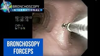 Flexible Bronchoscopy Basic Techniques for Forceps Biopsy [upl. by Jillayne468]